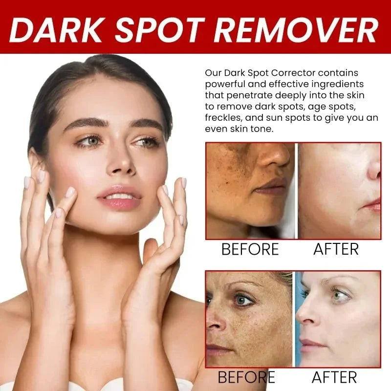 Powerful Spot-removing Whiten Cream Brighten Skin Fast Eliminates Melanin Pigmentation Melasma Dark Spots Korean Skin Care